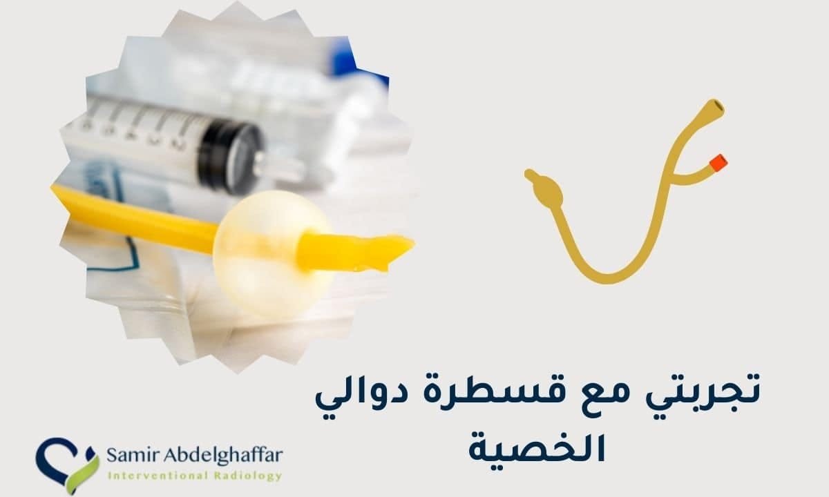 تجربتي مع قسطرة دوالي الخصية