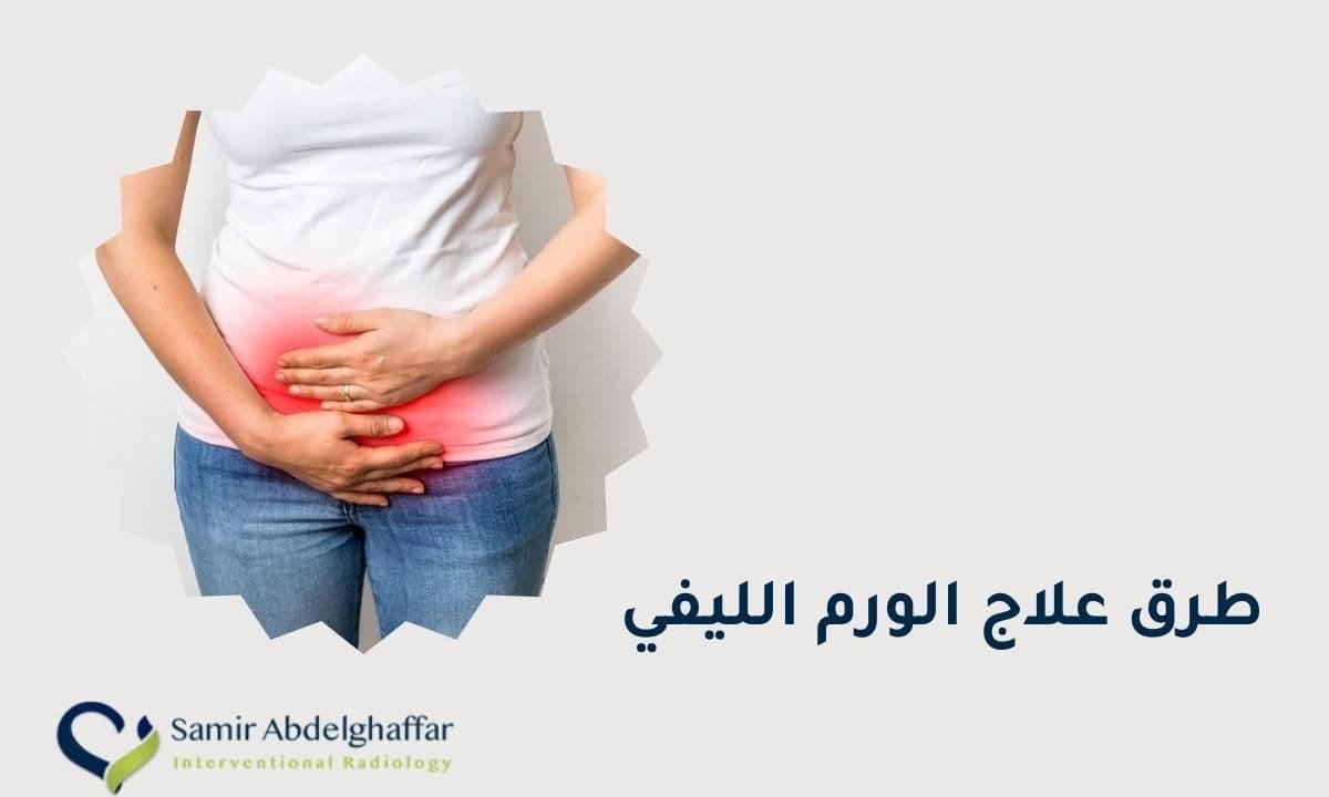 طرق علاج الورم الليفي