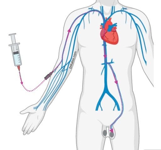 نصائح بعد قسطرة دوالي الخصية