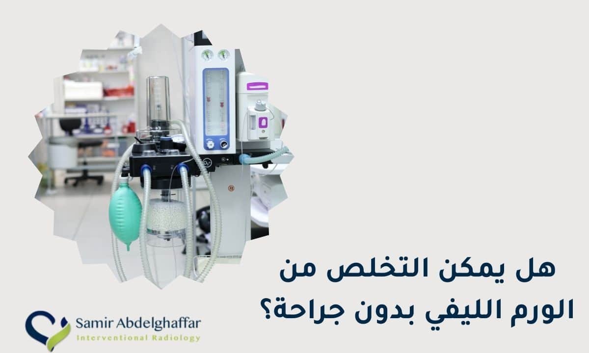 هل يمكن التخلص من الورم الليفي بدون جراحة؟