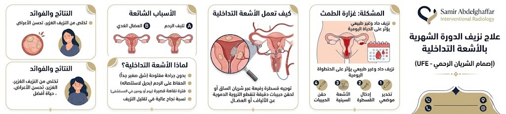 دور الاشعة التداخلية في علاج نزيف الدورة الشهرية
