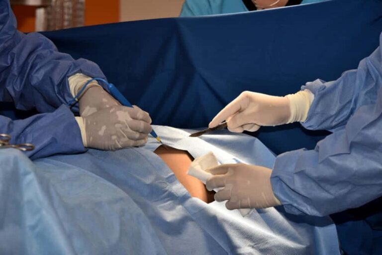 نسبة نجاح عملية دوالي الخصية