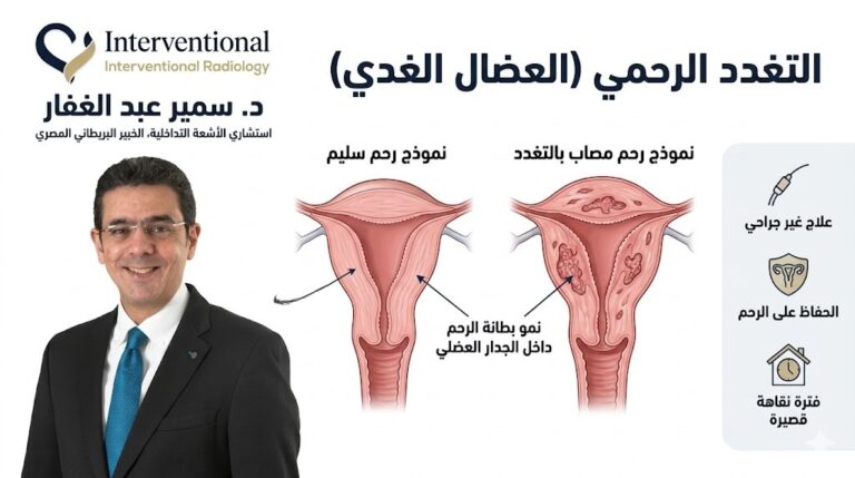علاج التغدد الرحمي العضال الغدي بدون جراحة مع د. سمير عبد الغفار