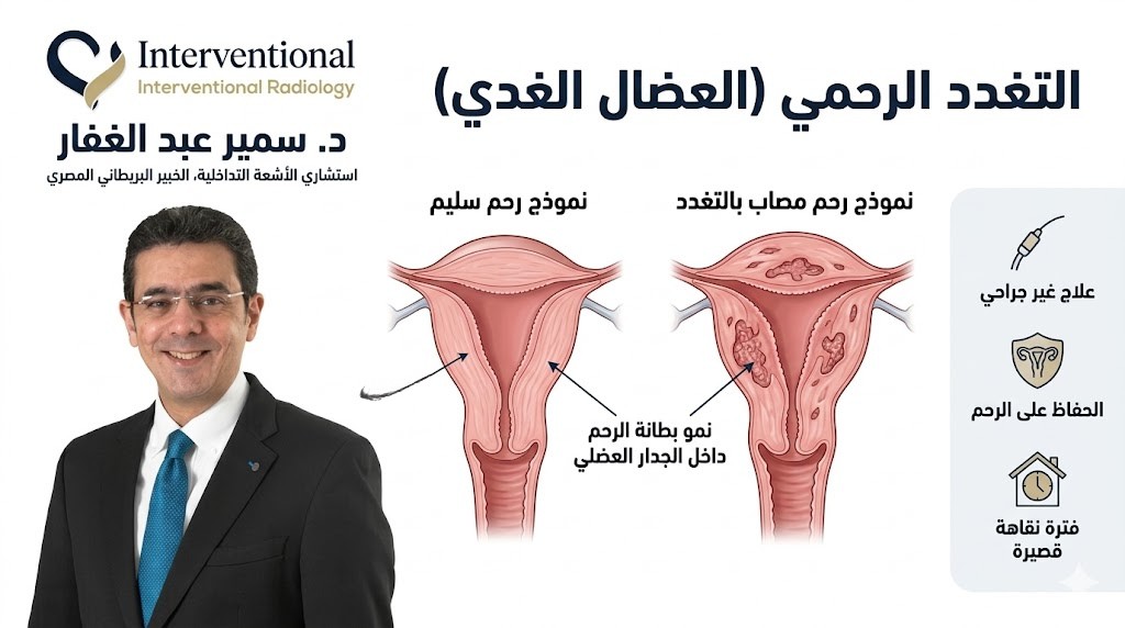 علاج التغدد الرحمي العضال الغدي بدون جراحة مع د. سمير عبد الغفار