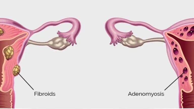 Adenomyosis