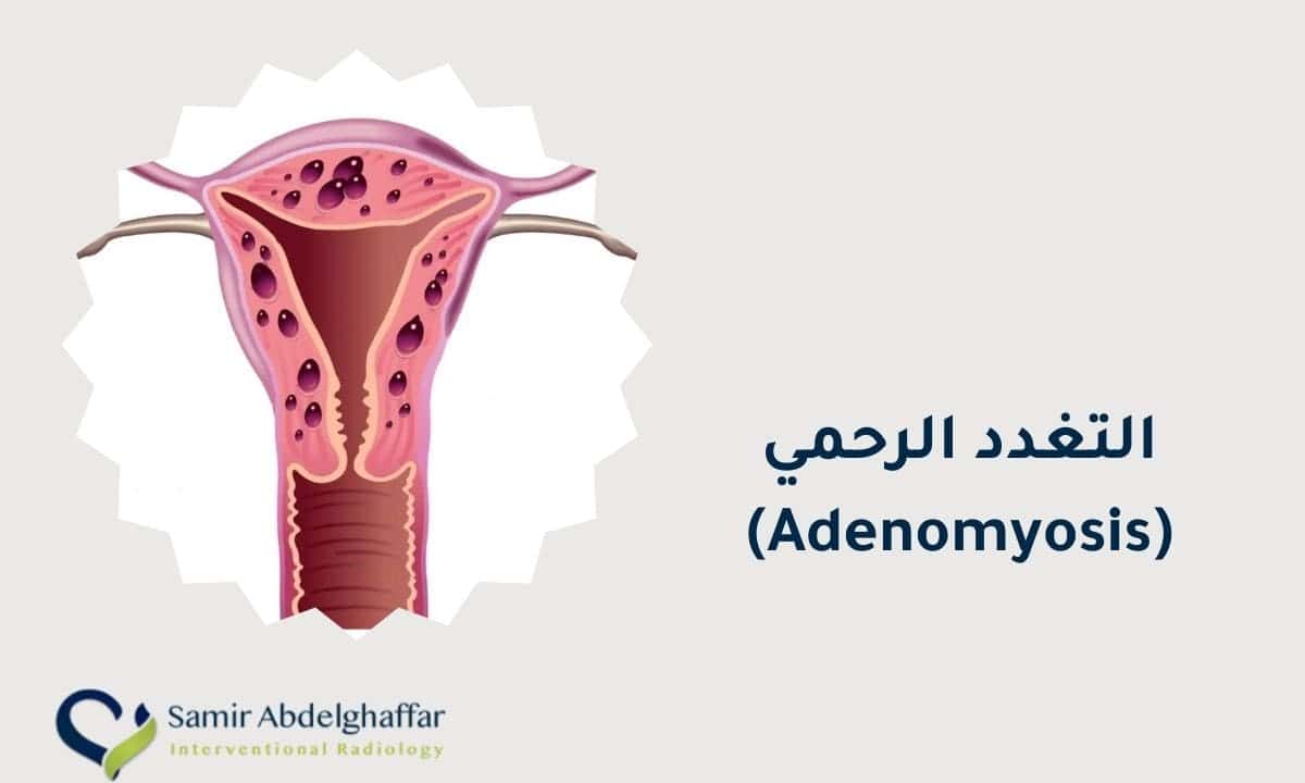 التغدد الرحمي | تغدد جدار الرحم | امكانية الحمل