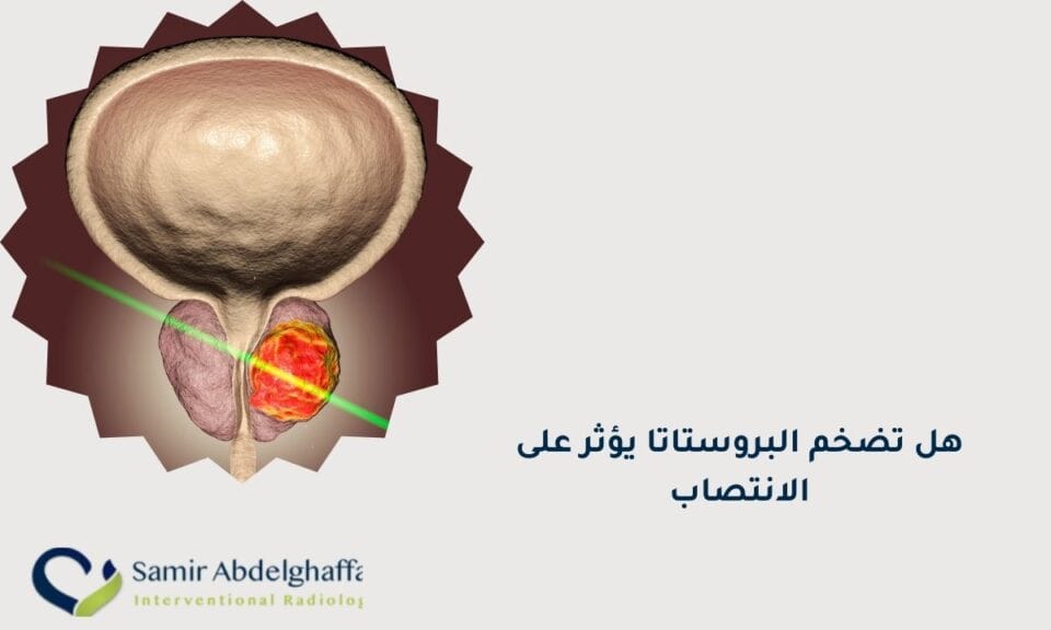 هل تضخم البروستاتا يؤثر على الانتصاب