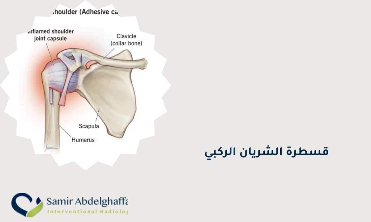 قسطرة الشريان الركبي