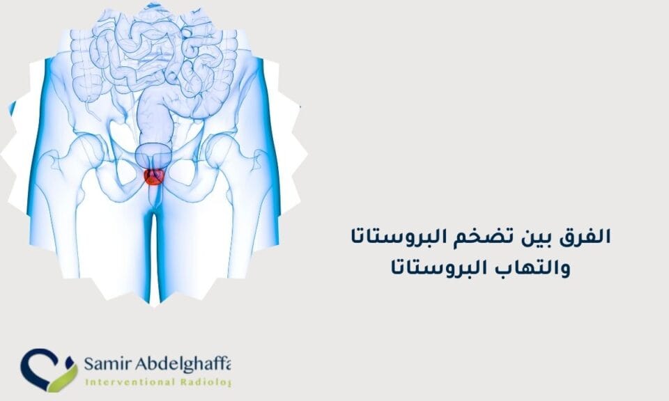 الفرق بين تضخم البروستاتا والتهاب البروستاتا