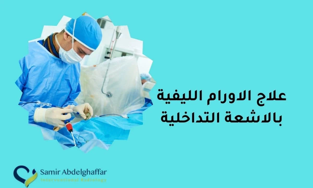 علاج الاورام الليفية بالاشعة التداخلية