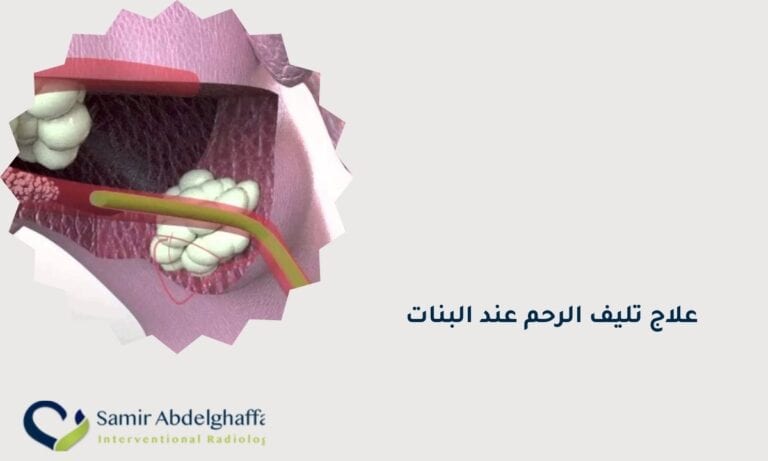 علاج تليف الرحم عند البنات