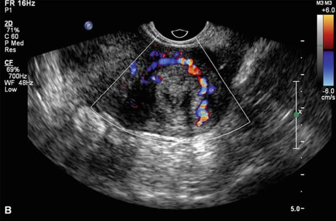 صورة بالسونار تظهر تليف الرحم ككتلة غير منتظمة داخل جدار الرحم.