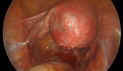 Large Uterine Adenomyosis