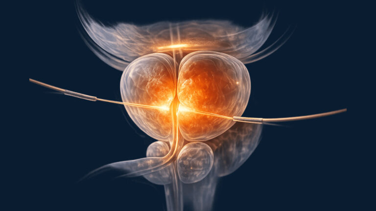 هل تقنية الإيكوليزر فعالة في علاج تضخم البروستاتا؟