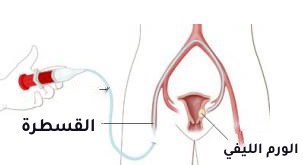 ‎⁨قسطرة الرحم للورم الليفي⁩